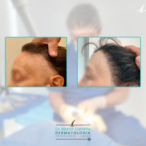 Antes y después alopecia en la mujer