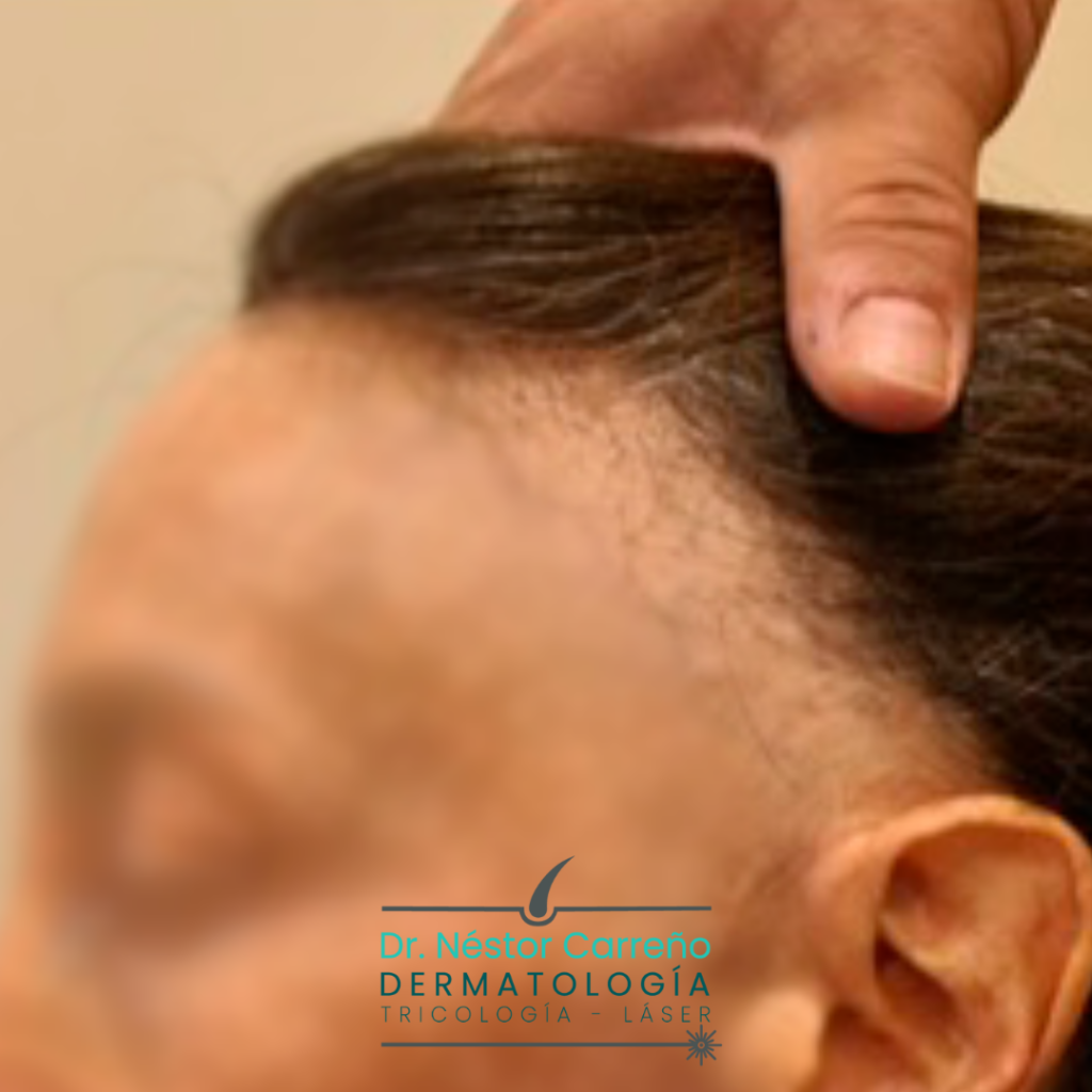 Caso real mujer con alopecia